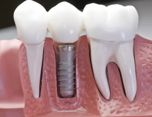 دندان از دست رفته خود را با ایمپلنت جایگزین کنید