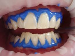  بلیچینگ تخصصی دندان