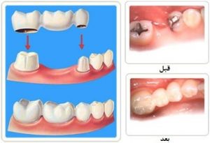 مزایای پروتز