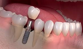 مزایای کاشت دندان 2