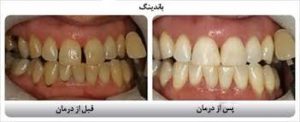 مزایای کامپوزیت های باند شونده دندانپزشکی