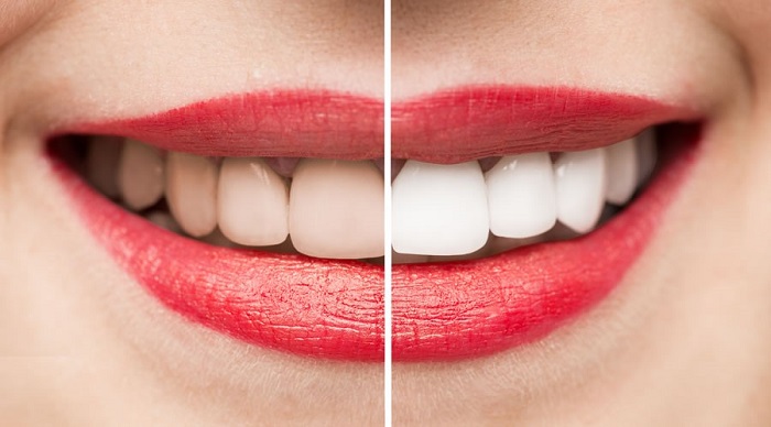 وش-های-مختلف-سفید-کردن-دندانر-