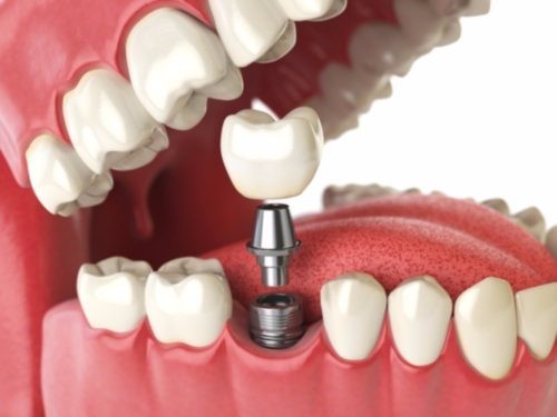 ایمپلنت یا کاشت دندان چیست؟ ( Dental Implant )
