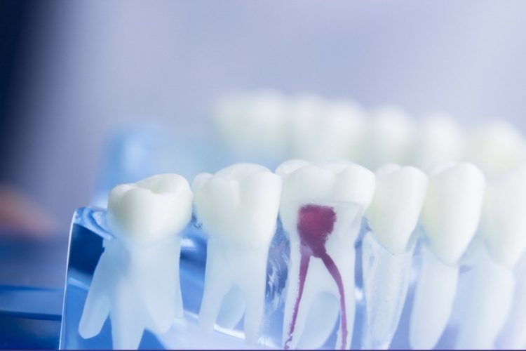 مراقبت های بین جلسات و پس از درمان ریشه دندان