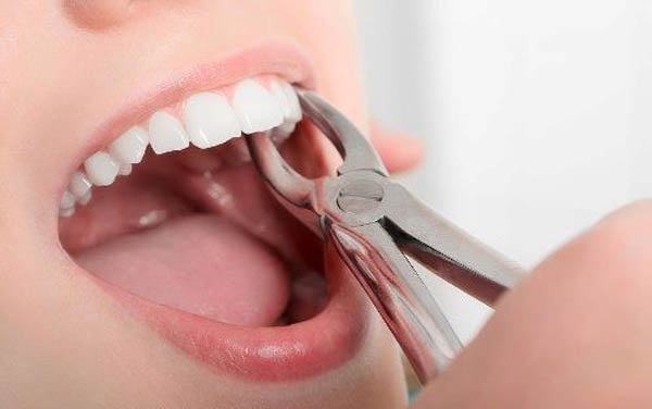 مراقبت های پس از درمان جراحی و کشیدن دندان